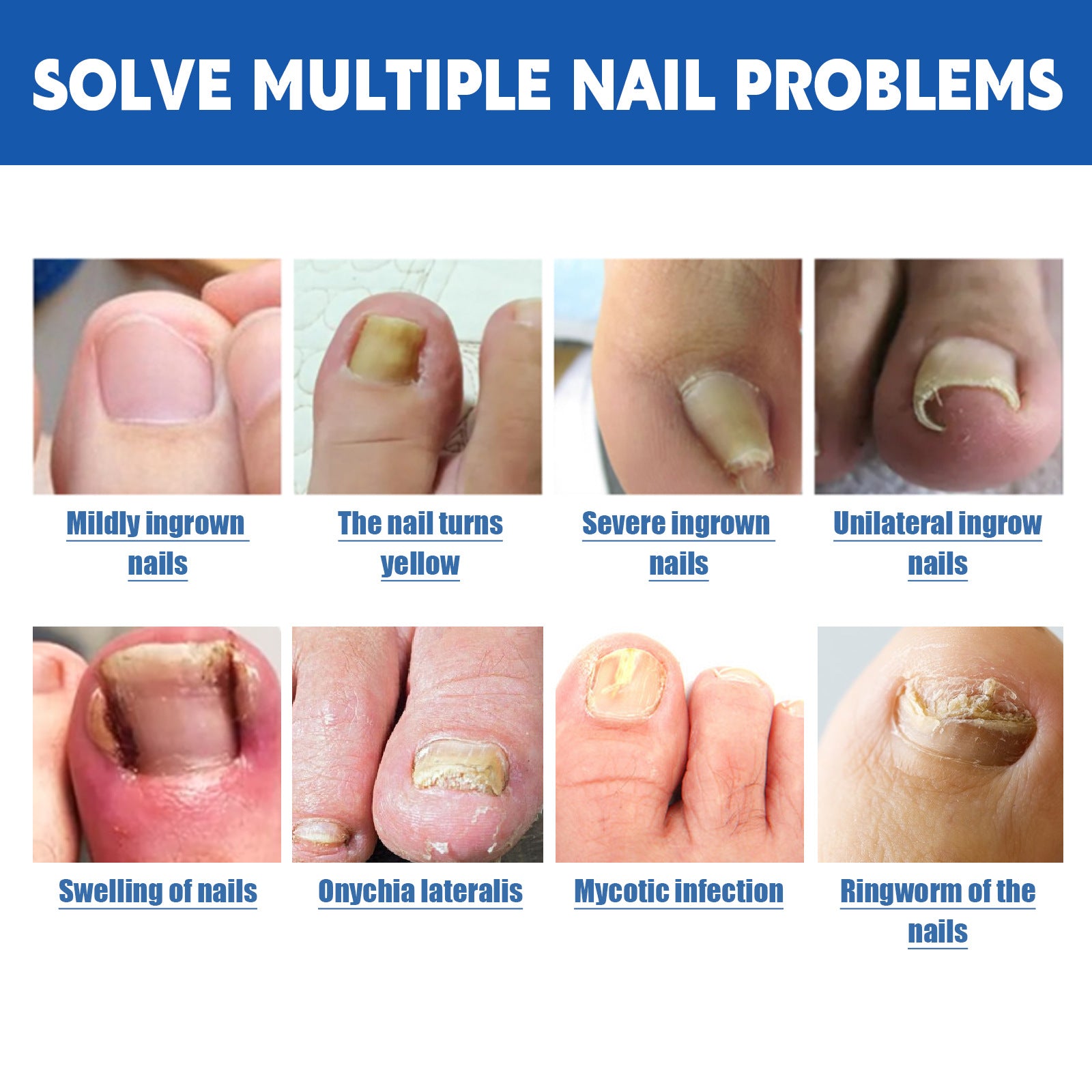 Jaysuing Nail Care Patches for Thickened Toenails