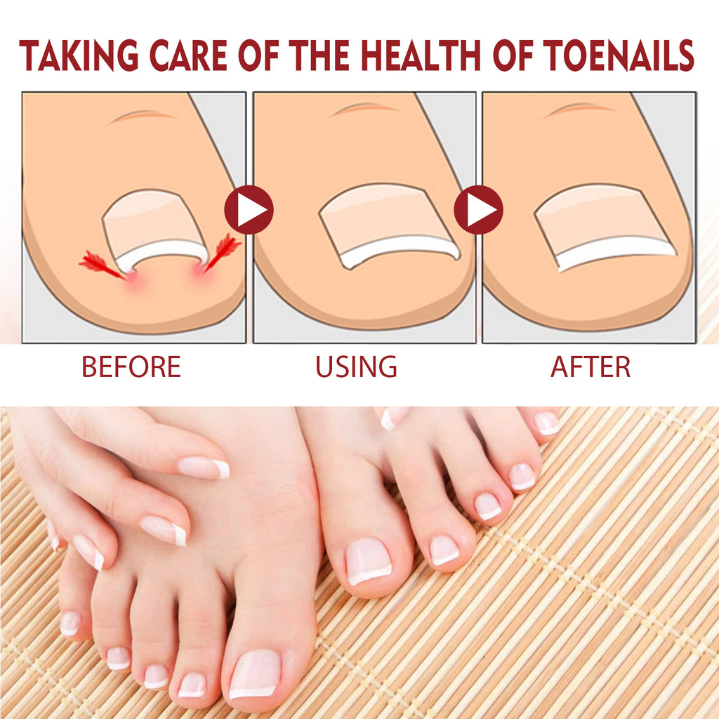 Jaysuing Anti-Inflammatory Nail Care Oil for Thick Nails