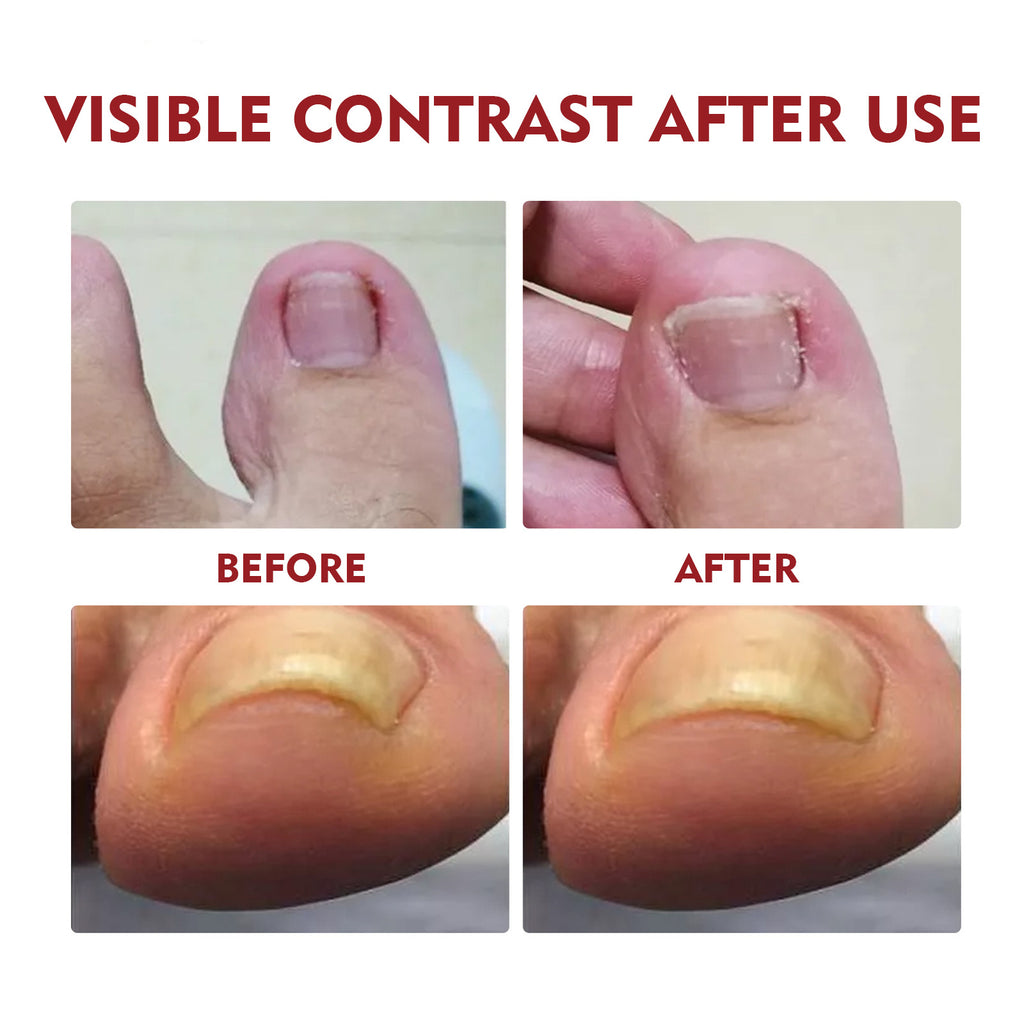 Jaysuing Anti-Inflammatory Nail Care Oil for Thick Nails